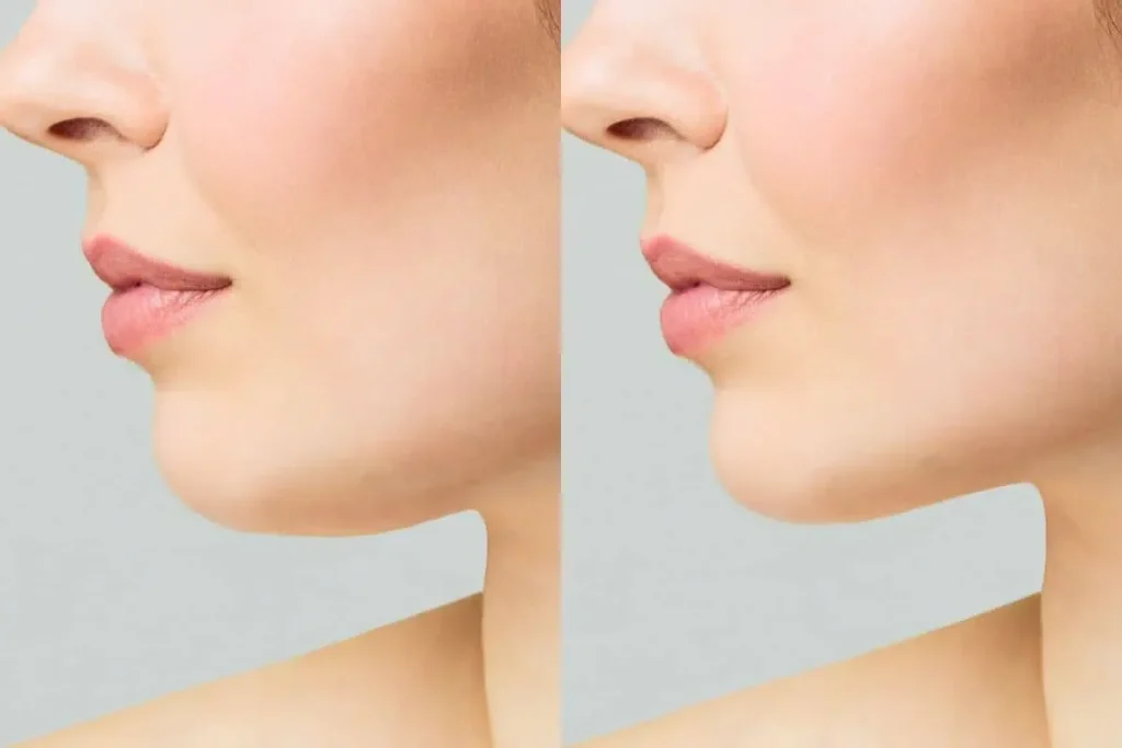 Fillers For Mouth Lines: Best Safety Guide
