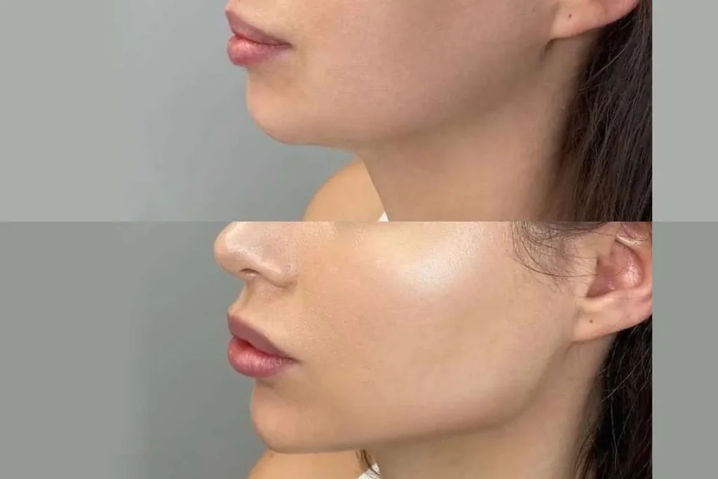 Fillers For Mouth Lines: Best Safety Guide