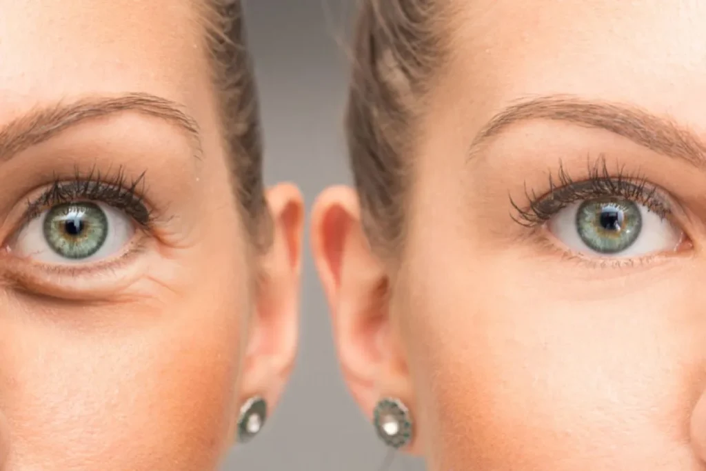 Face Swelling After Cheek Fillers: Help
