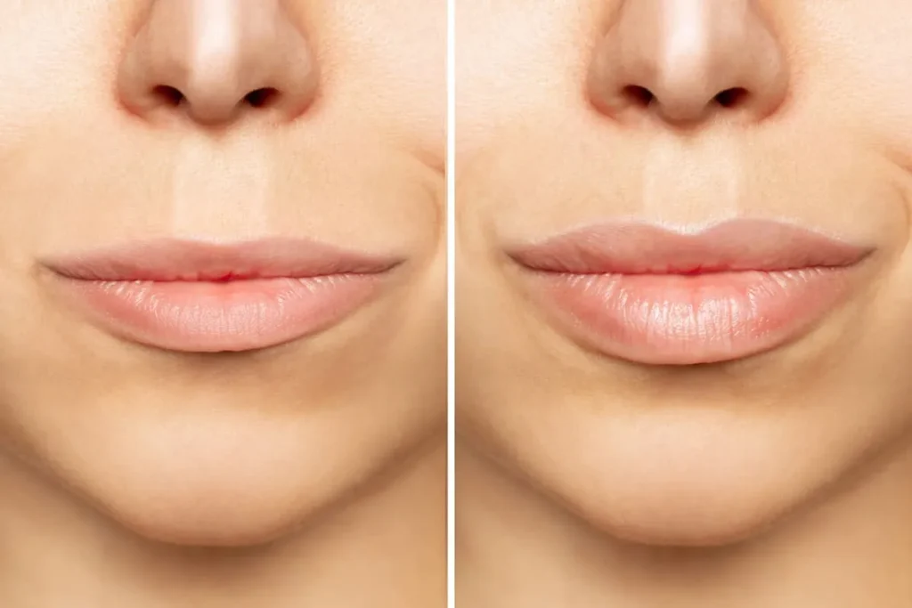 Different Lip Shapes With Fillers: Best Styles