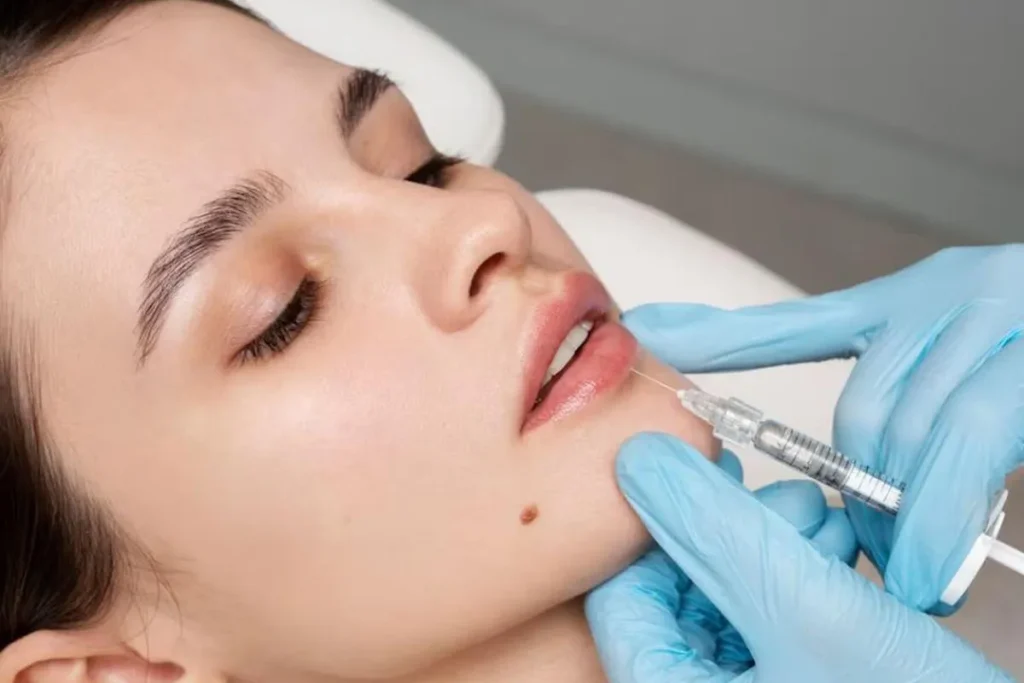 What Does Lip Filler Look Like? Visual Guide