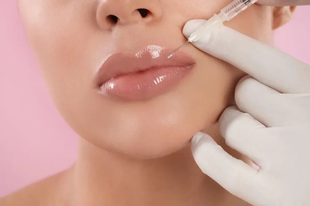 Lip Filler Examples: Stunning Before And After