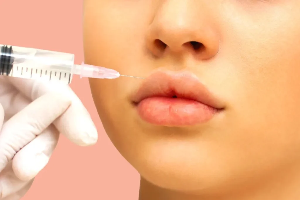 Lip Filler Examples: Stunning Before And After