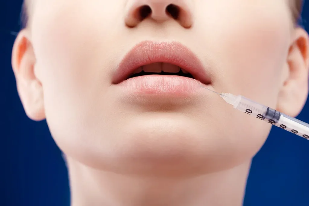 How Long Does Hyaluronic Acid Lip Filler Last?
