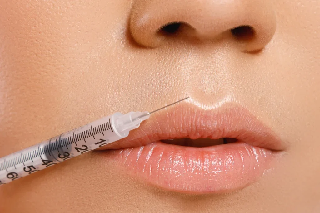 Does Lip Filler Last Forever? The Surprising Truth