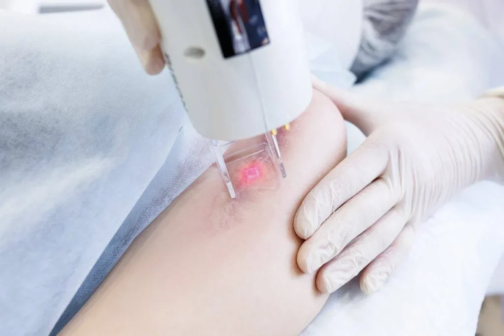 Scar Laser Redness: Brilliant Healing Guide
