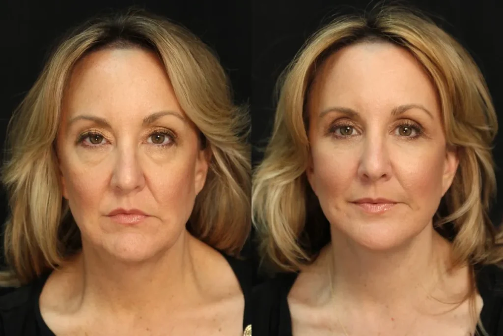 Mesotherapy Before And After: Stunning Results