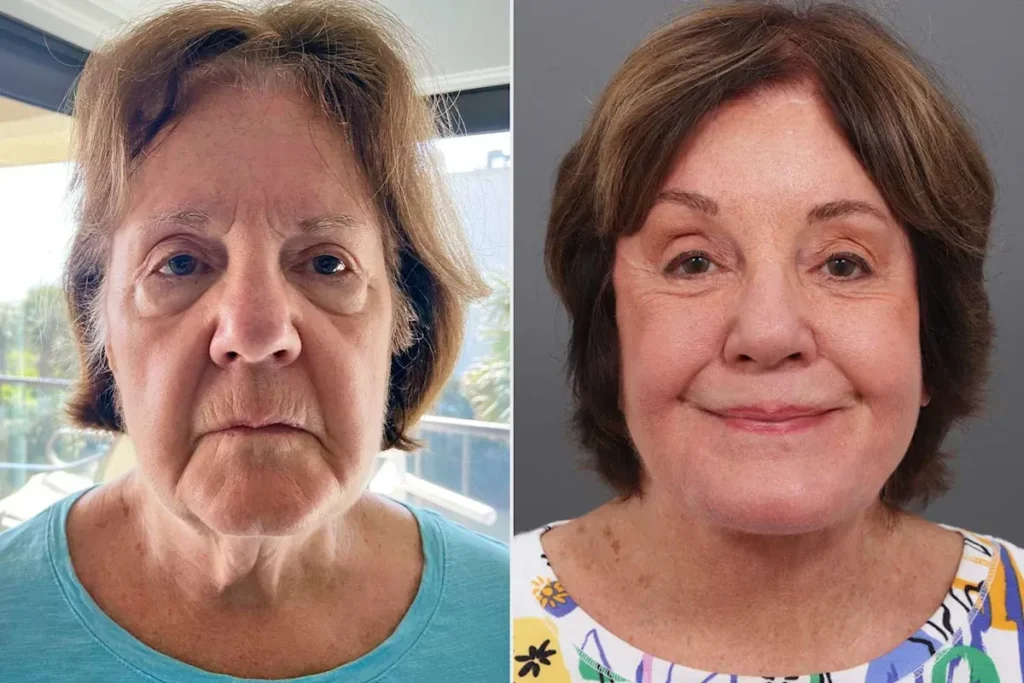 Mesotherapy Before And After: Stunning Results