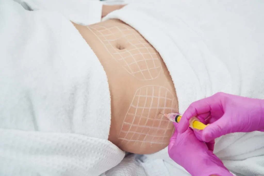 How Does Mesotherapy Work For Fat Loss? Tips