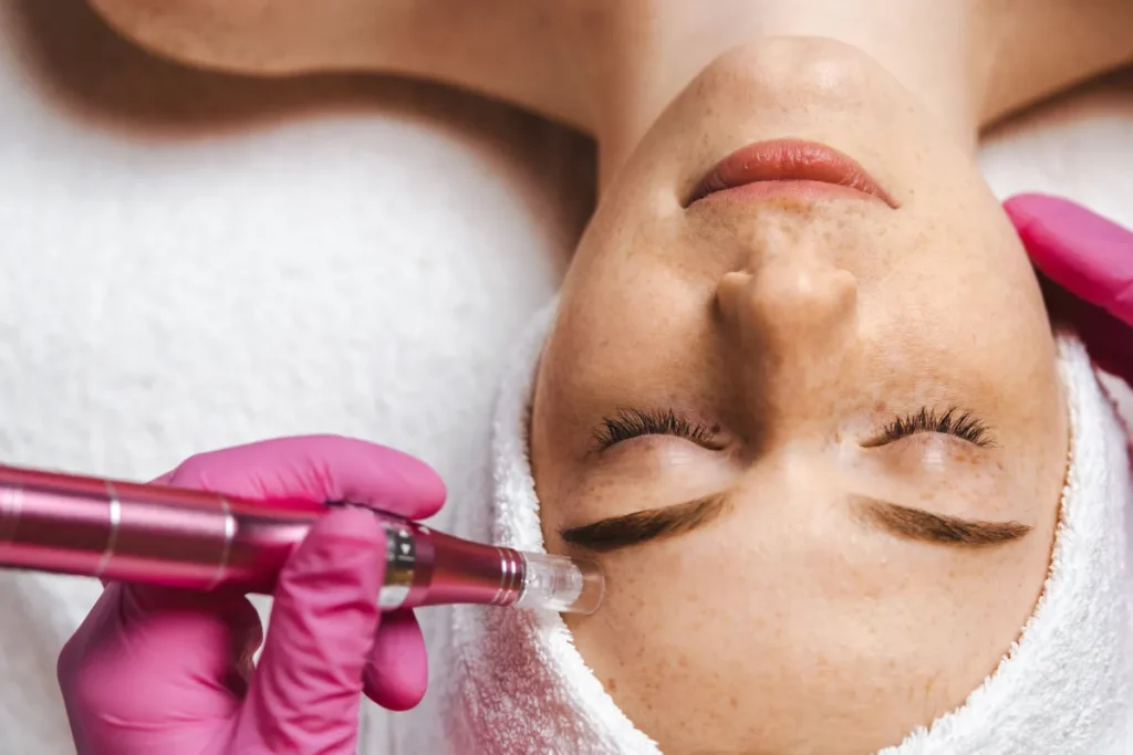 Mesotherapy Facial: Stunning Beauty Secrets