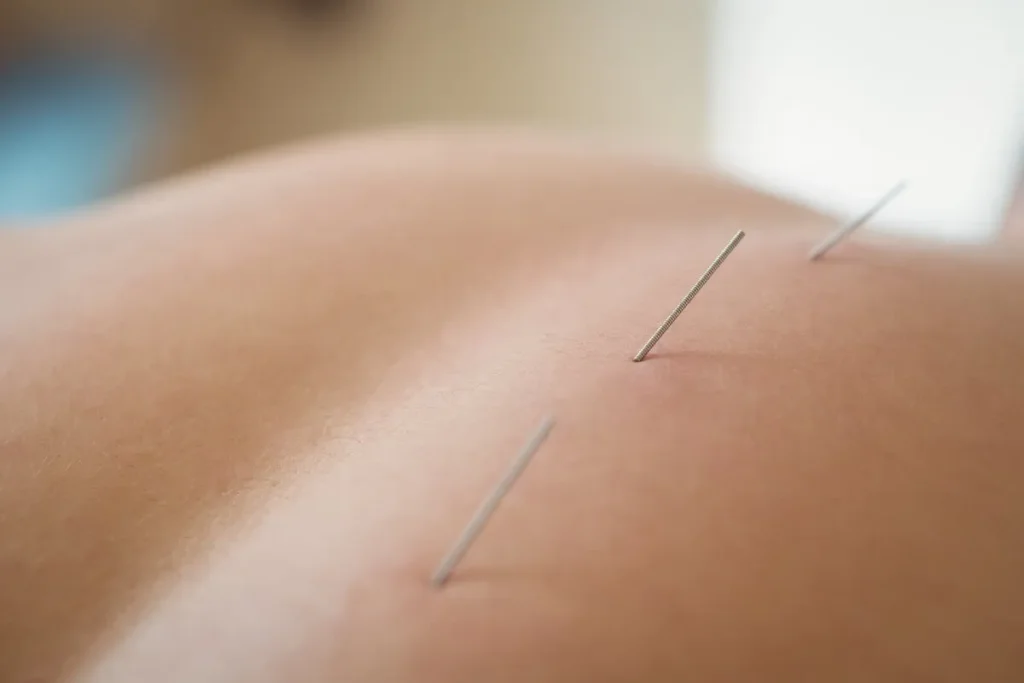 Trigger Injections: Complete Healing Guide