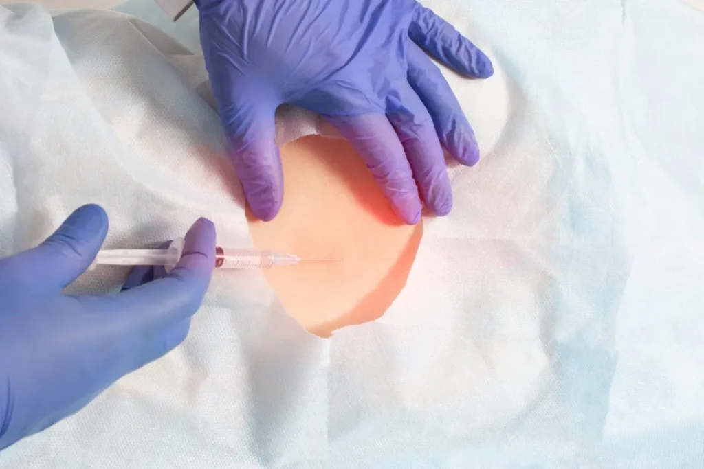 Trigger Point Injections Back: Ultimate Guide