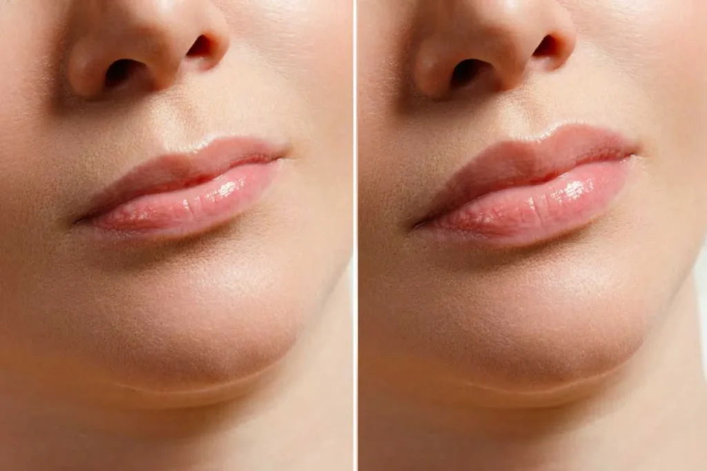 Natural Lip Fillers: Beautiful Results Fast