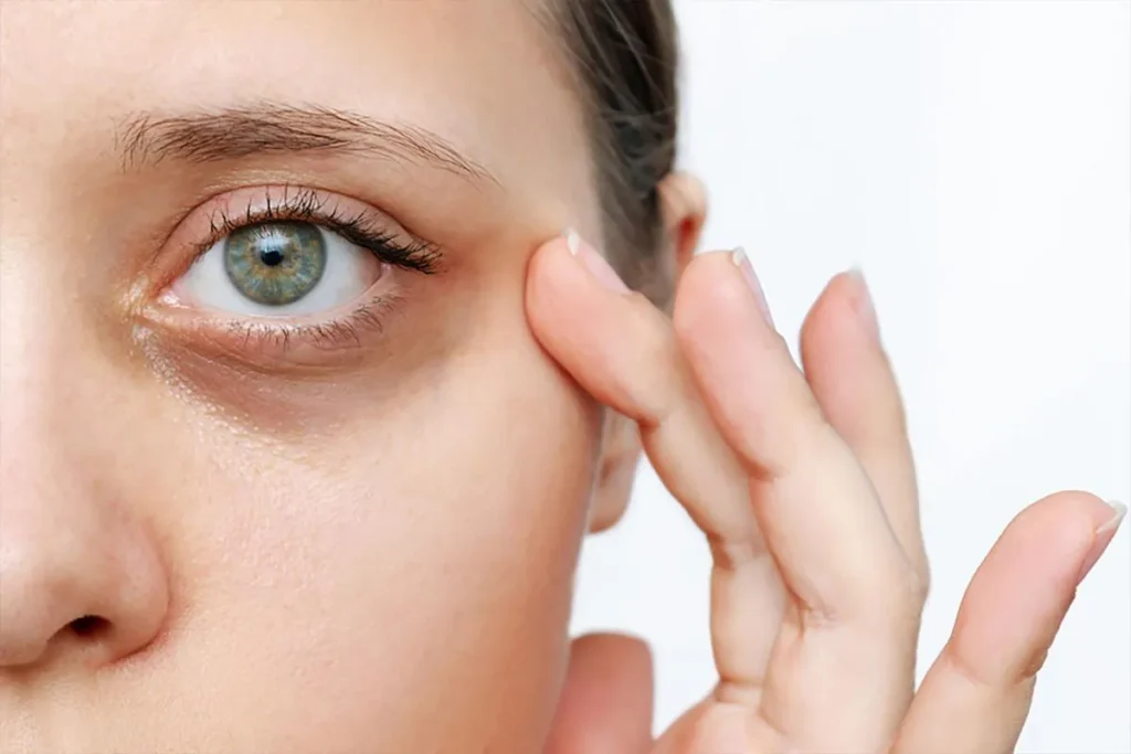 Shots For Under Eye Bags: Amazing Results Fast