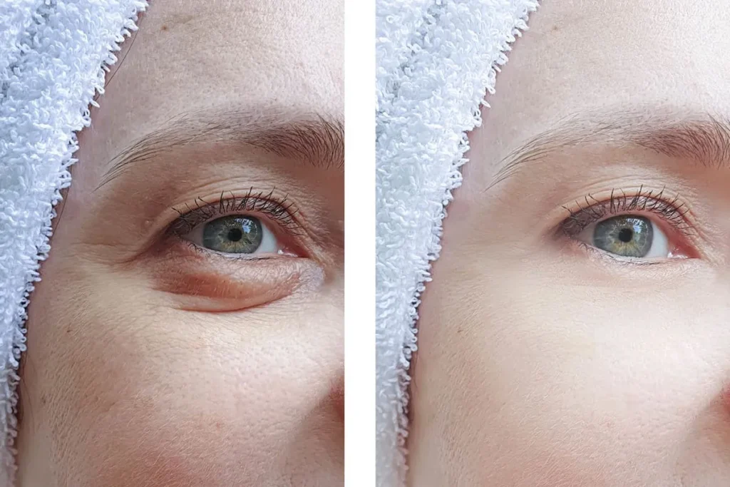 Oogzakvullers voor en na: Verbluffende resultaten