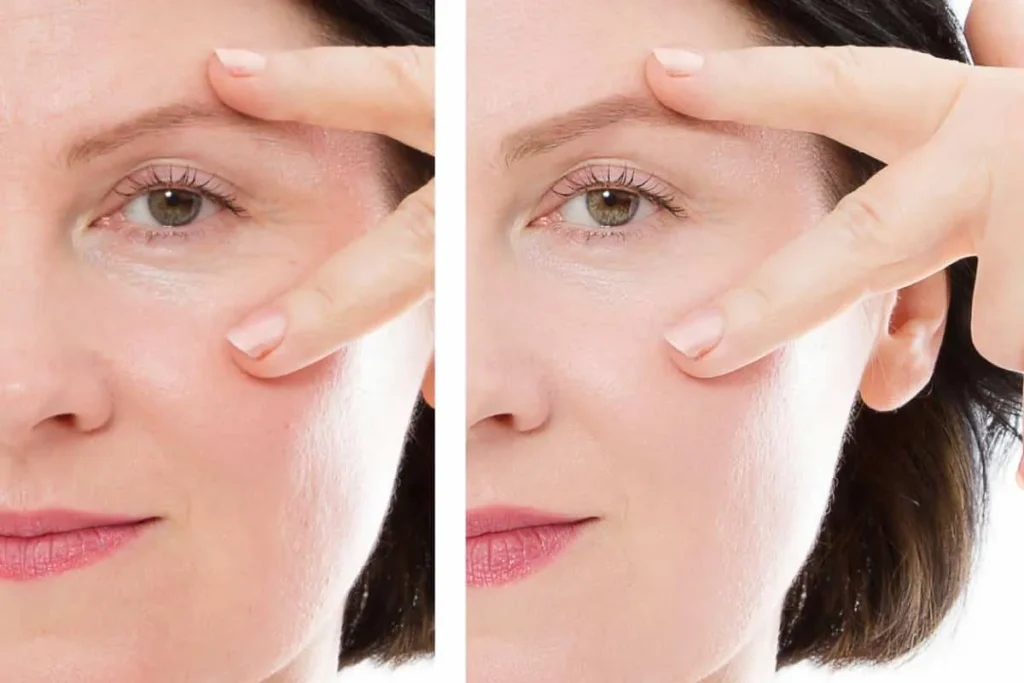 Dermal Filler Under Eyes Before And After