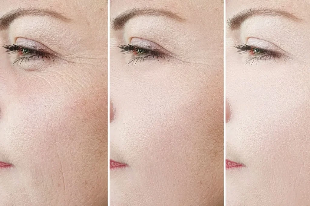 Tyndall Effect Under Eye Filler: Expert Facts