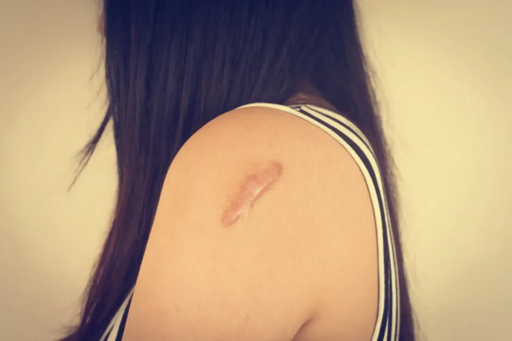 Tea Tree Oil For Scars: Amazing Relief Tips