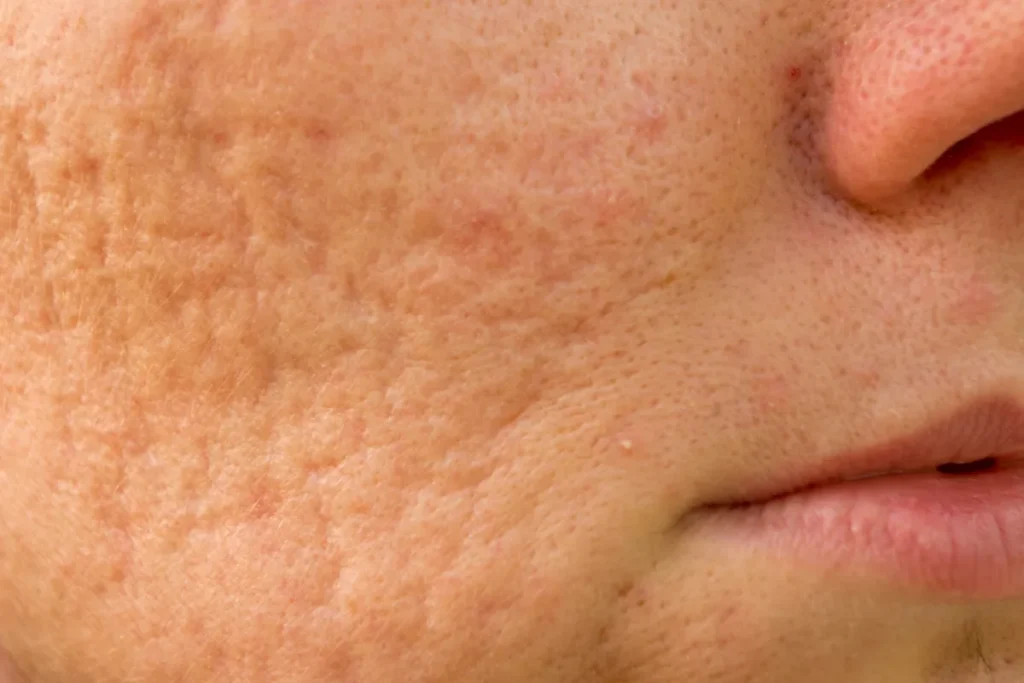 Huidverzorging Acne litteken verwijderen: Beste resultaten