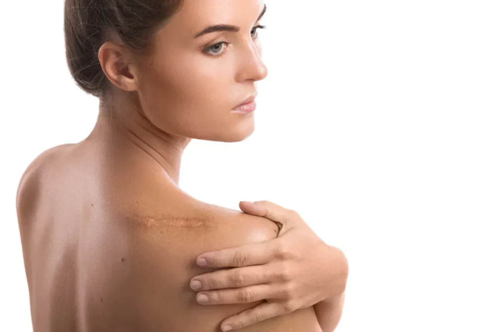 How To Get Rid Of Scar Tissue After Surgery: Tips