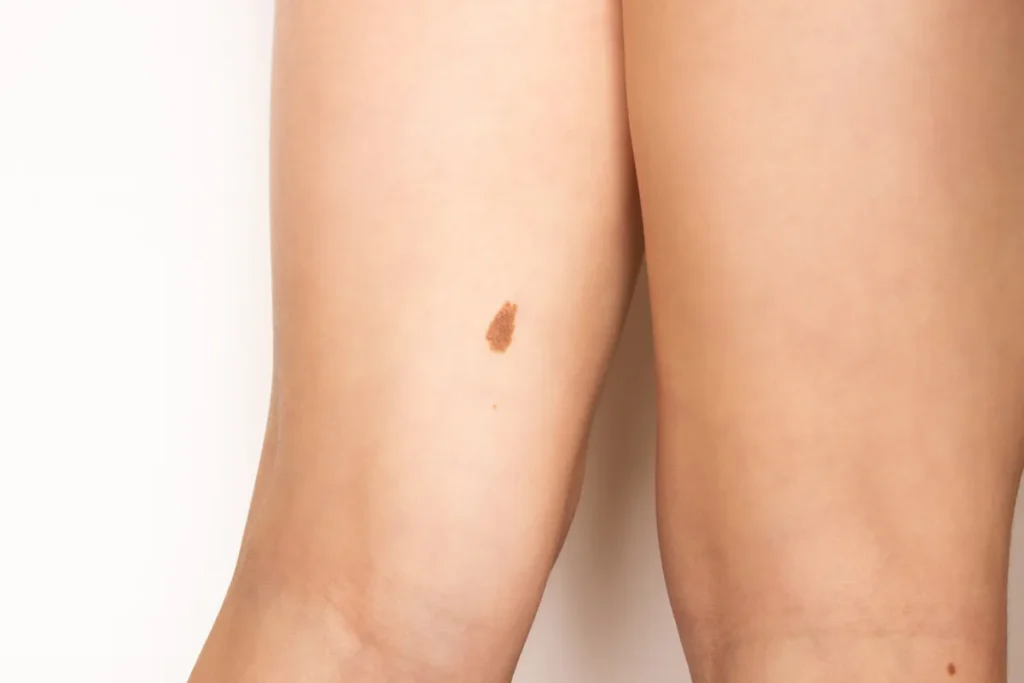 Why Do I Have Black Spots On My Hips? Facts