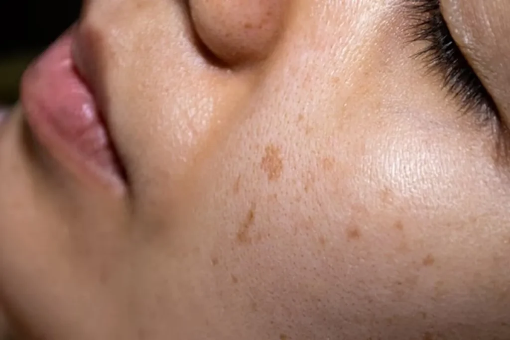 Brown Dots Appearing On Skin: Amazing Facts