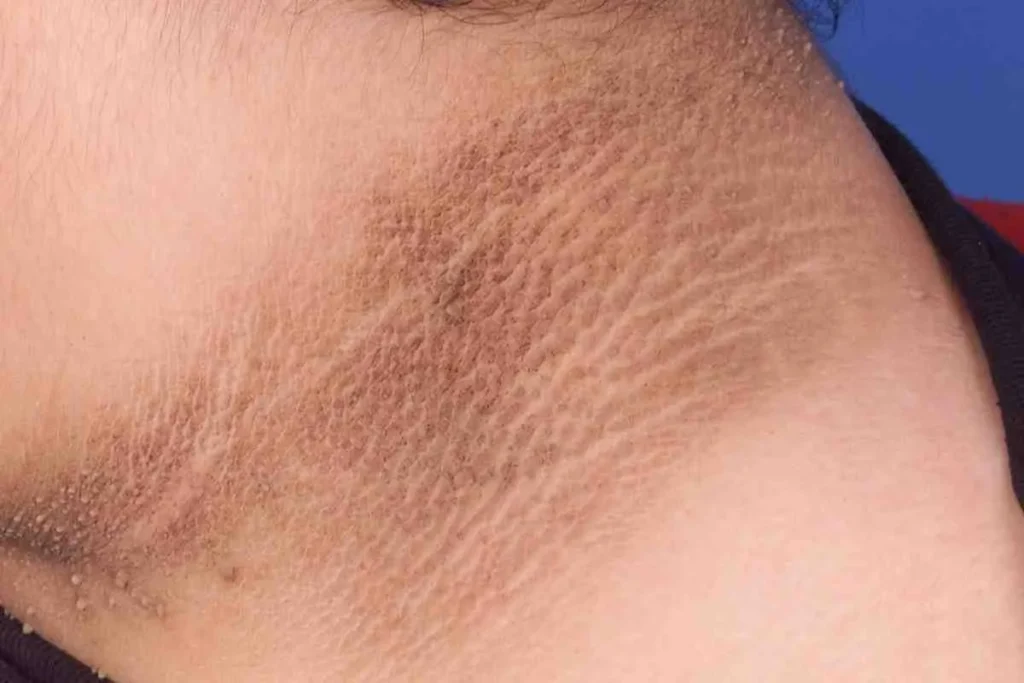 Black Marks On Stomach: Powerful Healing Tips