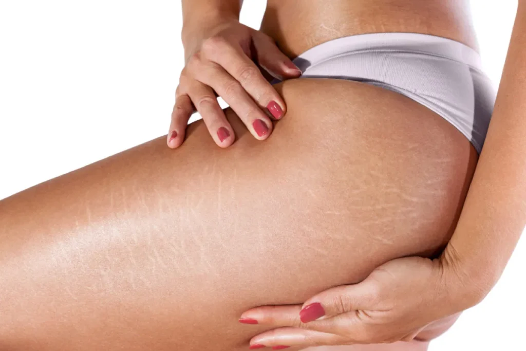 Zwarte vlekken op heupen: krachtige, verbazingwekkende resultaten