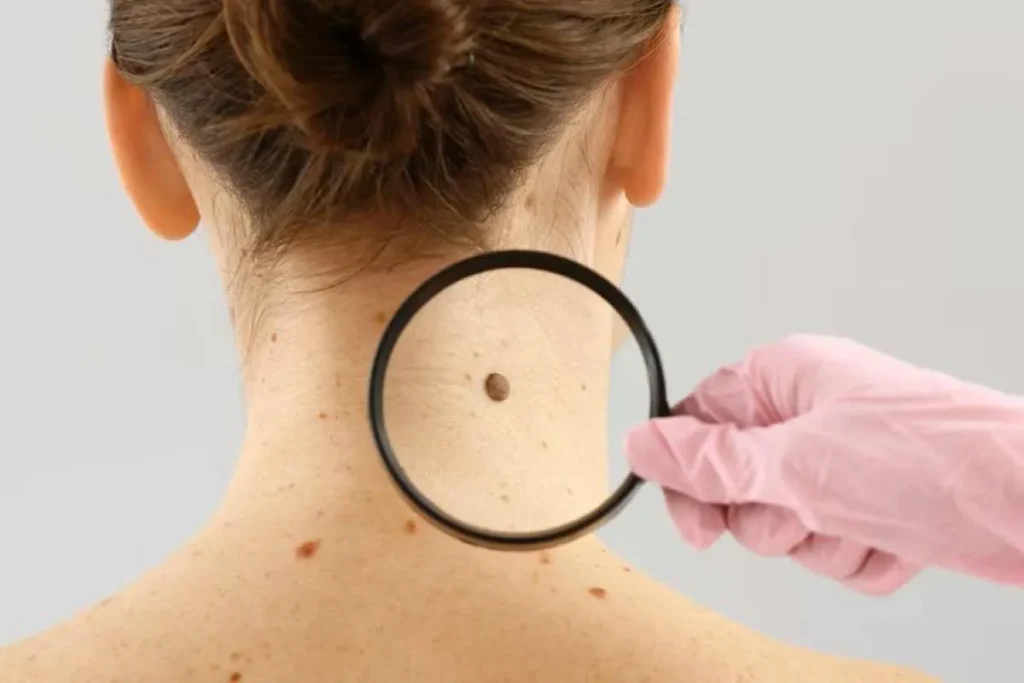 Black Freckles On Skin: Powerful Safety Guide