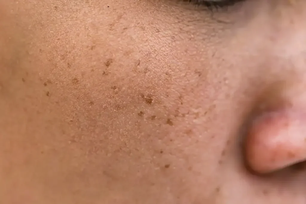 Wat zijn die bruine stippen op mijn huid? Geheimen