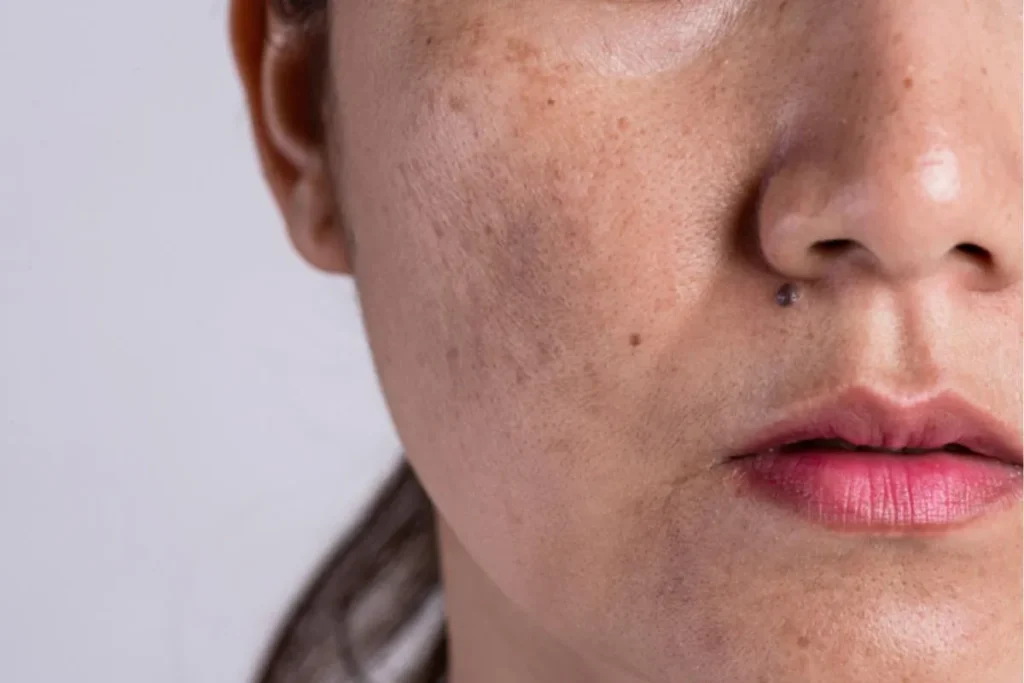 Wat zijn die bruine stippen op mijn huid? Geheimen