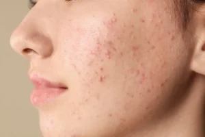 Hypertrophic Acne Scars: Powerful Amazing Fix
