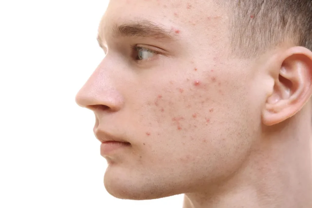 Hypertrophic Acne Scars: Powerful Amazing Fix