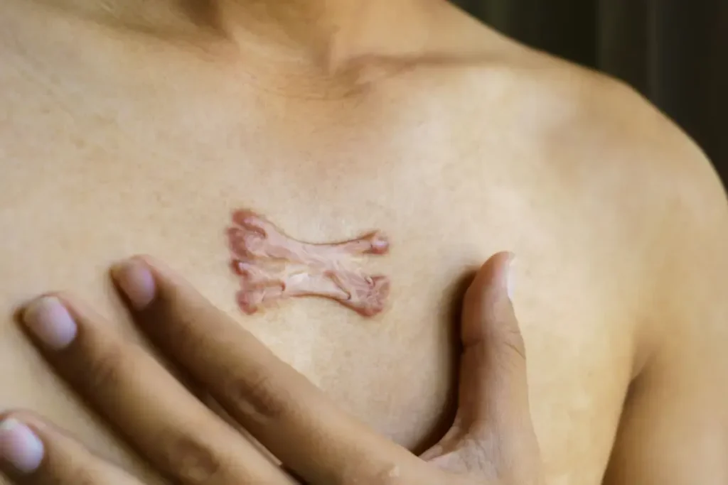 Chest Scars: Powerful Amazing Treatment Guide