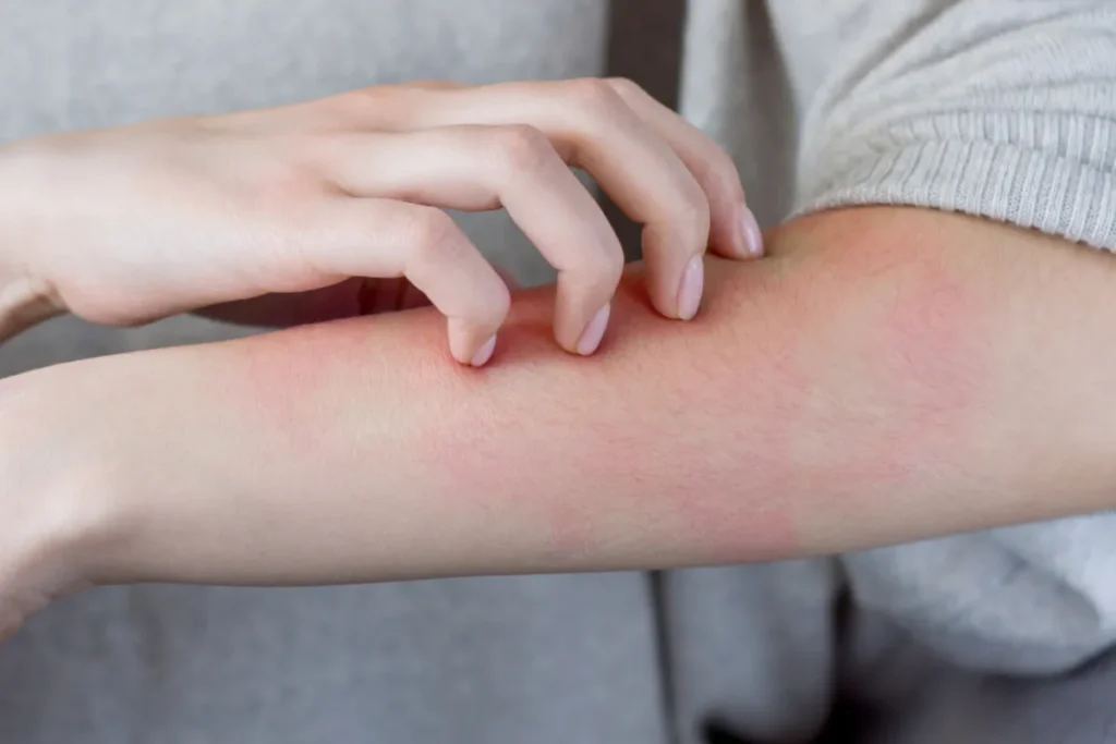 Why Is My Scar Itchy And Raised? Best Relief