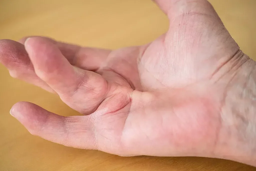 Scar On Finger: Powerful Amazing Healing Tips