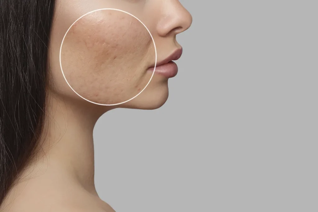 Waarom krijgt mijn huid zo gemakkelijk littekens? Verbazingwekkende feiten