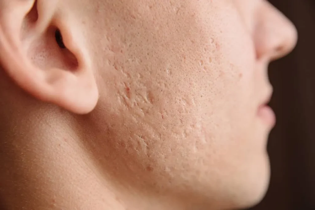 Will A Hypertrophic Scar Go Away? Best Secrets