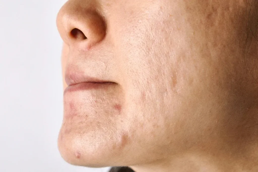 Will A Hypertrophic Scar Go Away? Best Secrets