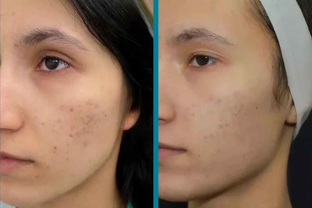 How To Stop Internal Scar Tissue From Growing