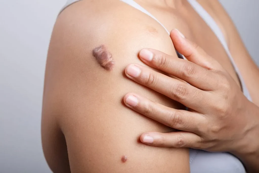 Can Hypertrophic Scars Go Away? Amazing Truth