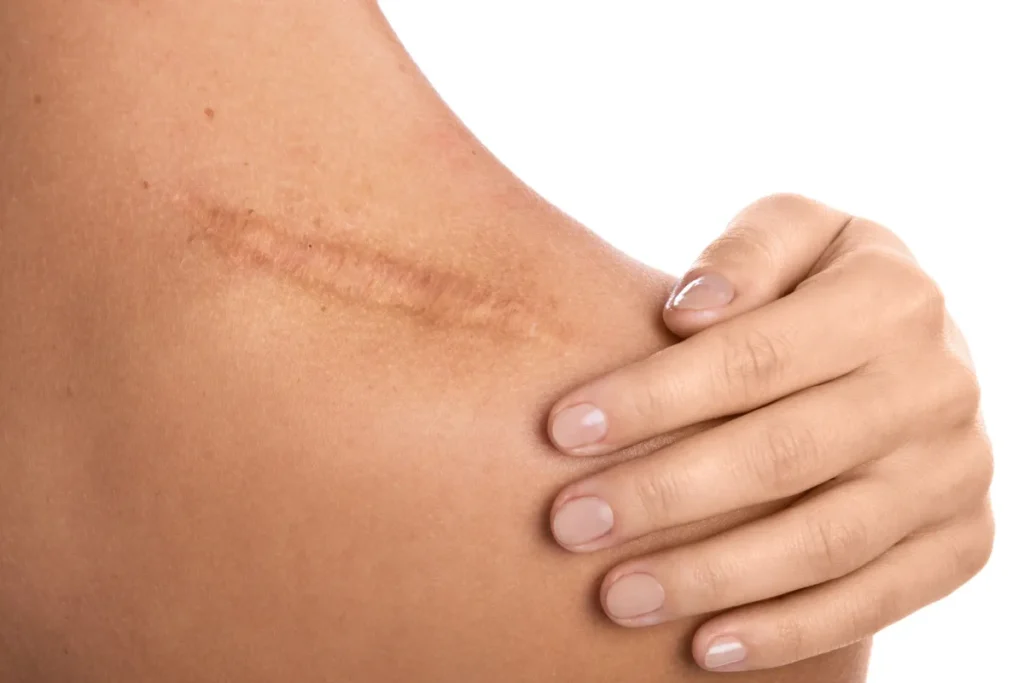 How Do I Know If I Have Scar Tissue? Best Tips