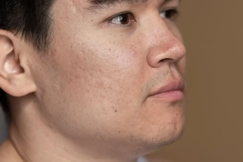 Boxcar Scars Before And After: Amazing Results