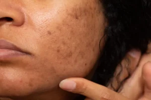 Various types of dark spots on the skin