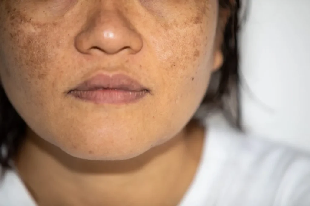 Donkere vlekken op een donkere huid: Krachtige Genezende Manieren