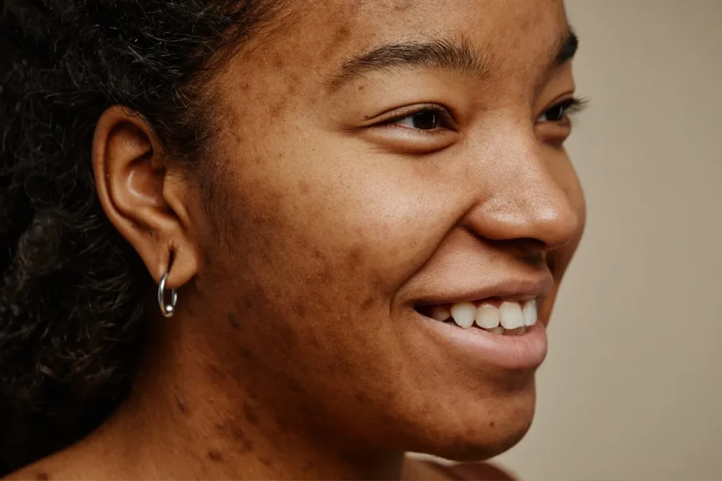 Dark Spots On Face Dark Skin: Amazing Results