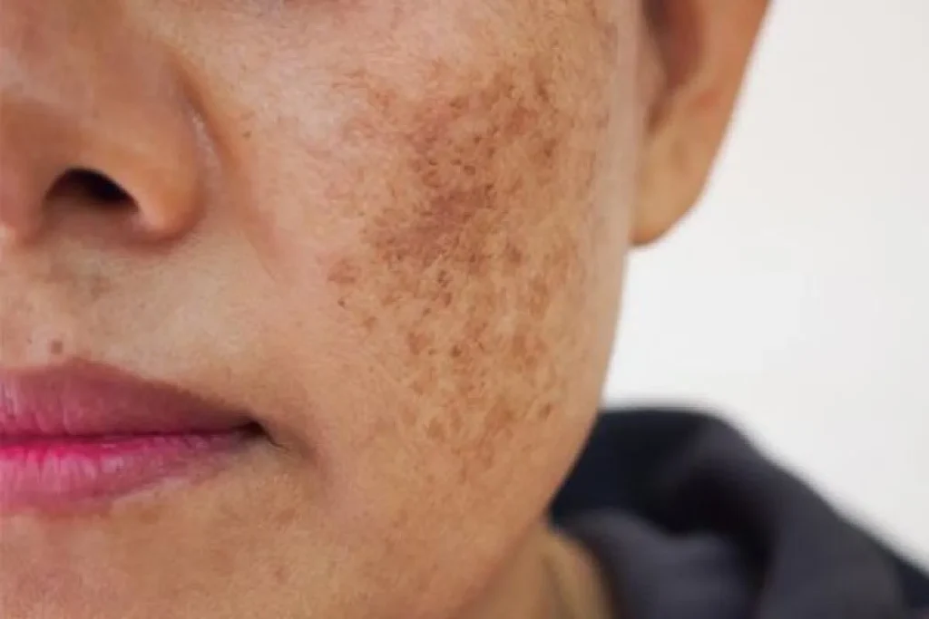 Dark Spots On Face Dark Skin: Amazing Results
