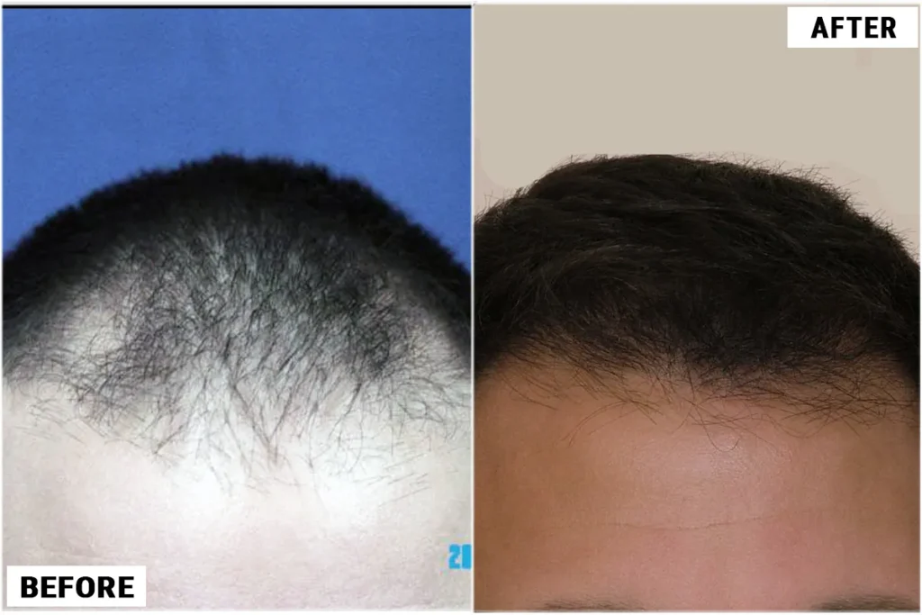 21 dagen na haartransplantatie: Kritische zorg