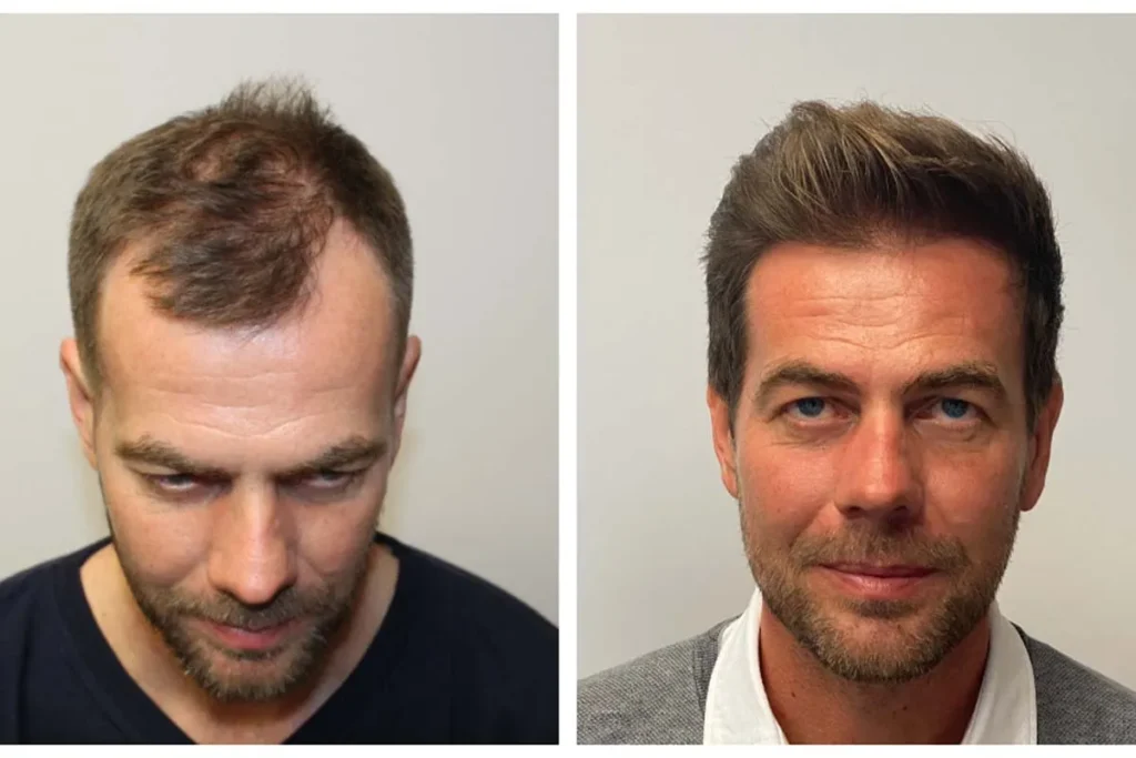 3 Month Hair Transplant Month By Month Results