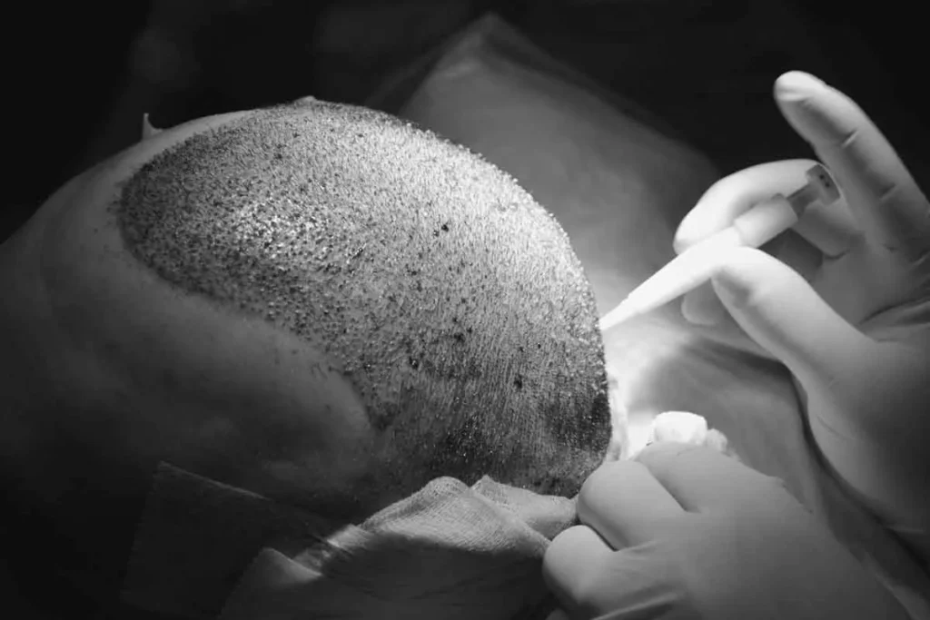 5 Maanden Na Haartransplantatie Chirurgie Resultaten